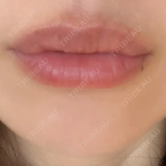 ヒアルロン酸注入（唇） アネシス美容クリニック DAY 6 メイン用