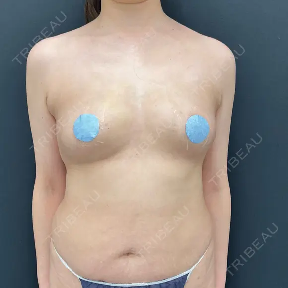 豊胸（脂肪注入） 湘南美容クリニック 吉祥寺院 AFTER メイン用