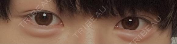 ヒアルロン酸注入（涙袋） PRO CLINIC プロクリニック 銀座院 AFTER メイン用