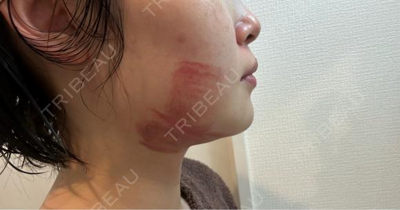 その他（輪郭） さっぽろ美容クリニック AFTER メイン用