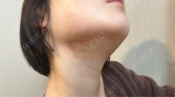 その他（輪郭） さっぽろ美容クリニック DAY 0 メイン用