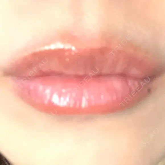 ヒアルロン酸注入（唇） アネシス美容クリニック DAY 7 メイン用