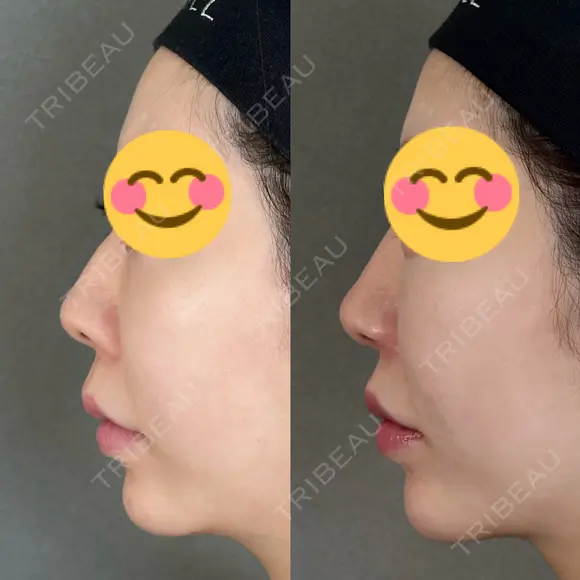 鼻尖形成（切開） / 人中短縮 / 鼻孔縁挙上 / その他（鼻） アリエル美容クリニック 大宮院 DAY 182 メイン用