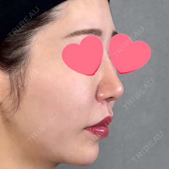 鼻尖形成（切開） / 人中短縮 / 鼻孔縁挙上 / その他（鼻） アリエル美容クリニック 大宮院 DAY 182 メイン用