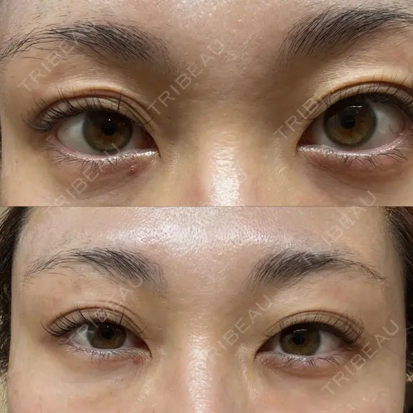 眼瞼下垂（非切開） SOL CLINIC AFTER メイン用