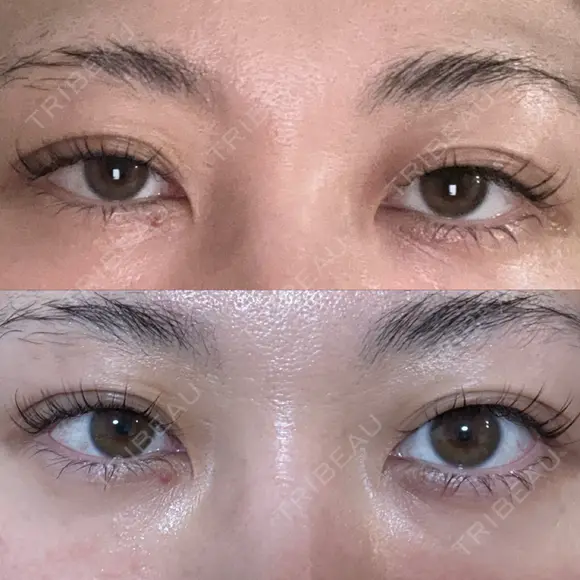 眼瞼下垂（非切開） SOL CLINIC DAY 0 メイン用