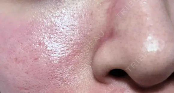 毛穴洗浄（ハイドラフェイシャルなど） / ピコフラクショナルレーザー（毛穴・ニキビ跡） 心斎橋KT美容クリニック DAY 0 メイン用