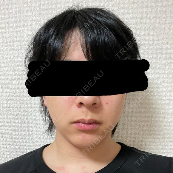 糸リフト / 脂肪吸引（顔） / 脂肪吸引注射（顔） / ヒアルロン酸注入（あご） SEA CLINIC（シークリニック） DAY 35 メイン用