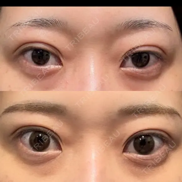 二重埋没 湘南美容クリニック 池袋東口院 DAY 8 メイン用