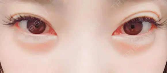 ヒアルロン酸注入（涙袋） ネビュラクリニック 東京錦糸町院 AFTER メイン用