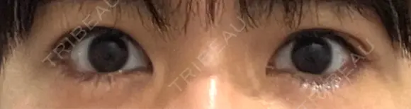 タレ目形成・グラマラスライン（埋没） LOUIS CLINIC 二子玉川院【ルイクリニック】 DAY 1 メイン用