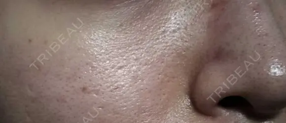 毛穴洗浄（ハイドラフェイシャルなど） / ピコフラクショナルレーザー（毛穴・ニキビ跡） 心斎橋KT美容クリニック DAY 1 メイン用