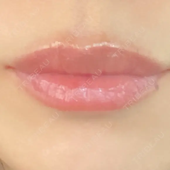 ヒアルロン酸注入（唇） アネシス美容クリニック DAY 8 メイン用