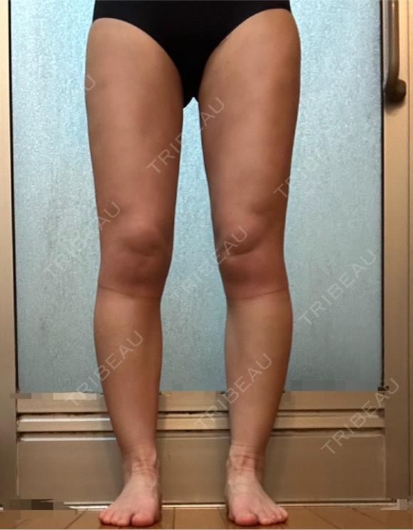 脂肪吸引（脚） / 豊胸（脂肪注入） オアシス美容外科 DAY 41 メイン用