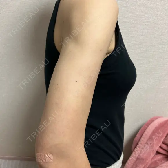 脂肪吸引（二の腕） / 脂肪吸引（肩） 湘南美容クリニック 高田馬場院 DAY 31 メイン用