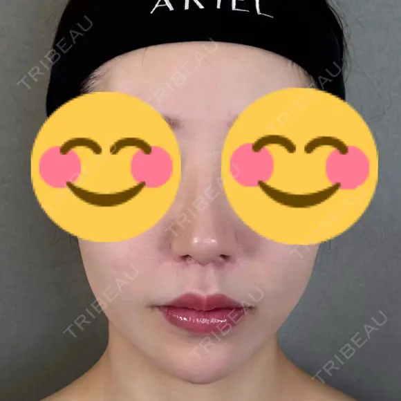 鼻尖形成（切開） / 人中短縮 / 鼻孔縁挙上 / その他（鼻） アリエル美容クリニック 大宮院 DAY 182 メイン用