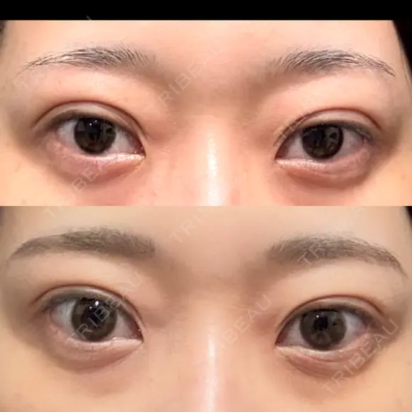 二重埋没 湘南美容クリニック 池袋東口院 DAY 9 メイン用