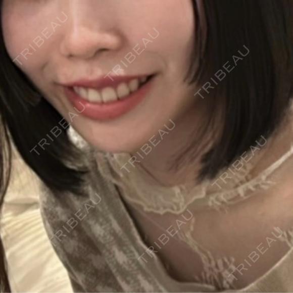 糸リフト 仙台TAクリニック AFTER メイン用
