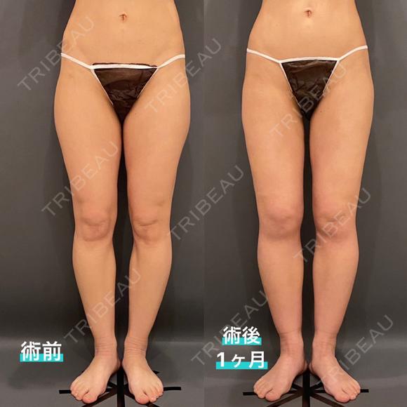 脂肪吸引（脚） / 豊胸（脂肪注入） オアシス美容外科 DAY 36 メイン用