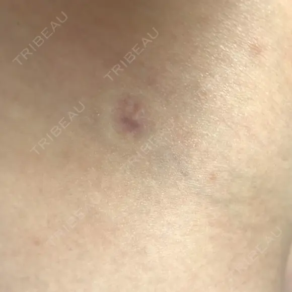 脂肪吸引（脚） / 脂肪吸引（お尻） ドクターフィット（Dr.fit）クリニック DAY 89 メイン用