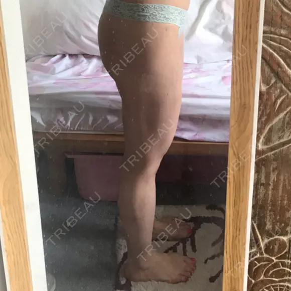 脂肪吸引（脚） / 脂肪吸引（お尻） ドクターフィット（Dr.fit）クリニック DAY 89 メイン用