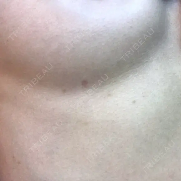 豊胸（脂肪注入） ドクターフィット（Dr.fit）クリニック DAY 89 メイン用