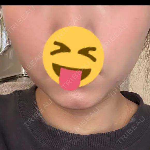 ボトックス（エラ・小顔） 新未来クリニック AFTER メイン用