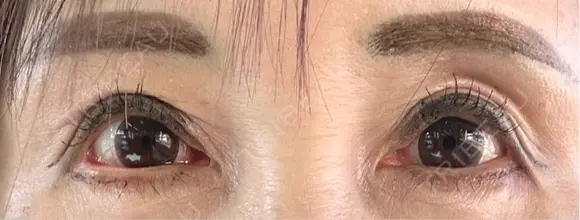 二重切開 / 眼瞼下垂（切開） / 上まぶたたるみ取り / 眉下切開 / 脂肪吸引注射（顔） / 肌ヒアルロン酸注入（たるみ・シワ改善） 東京シンデレラ美容外科 新宿院 DAY 147 メイン用
