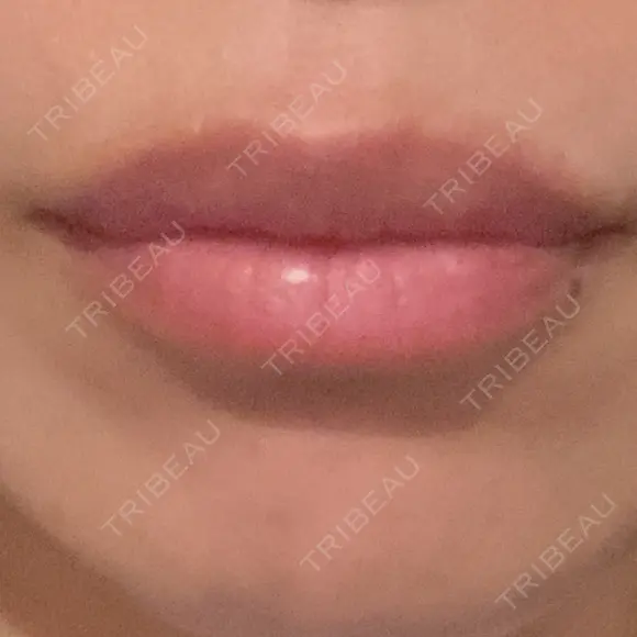 ヒアルロン酸注入（唇） アネシス美容クリニック AFTER メイン用