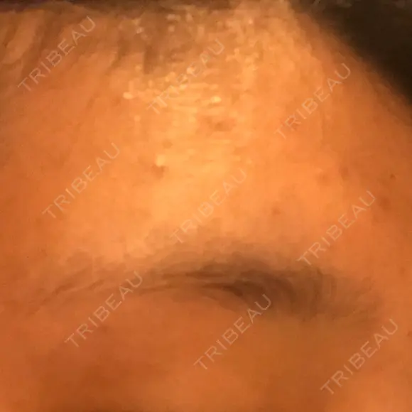 医療脱毛（顔） LIFIX BEAUTY CLINIC AFTER メイン用