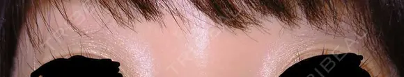 その他（目元） / ヒアルロン酸注入（目の下） あきこクリニック AFTER メイン用