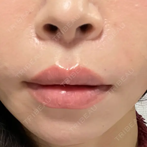 肌ヒアルロン酸注入（たるみ・シワ改善） MEMOTO CLINIC 名古屋 DAY 0 メイン用