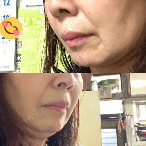 ルメッカ BAO CLINIC 神戸院 DAY 0 メイン用