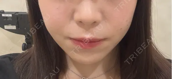 ボトックス（エラ・小顔） / ヒアルロン酸注入（鼻翼基部） KAGA CLINIC DAY 0 メイン用