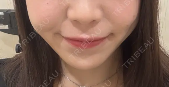 ボトックス（エラ・小顔） / ヒアルロン酸注入（鼻翼基部） KAGA CLINIC DAY 0 メイン用