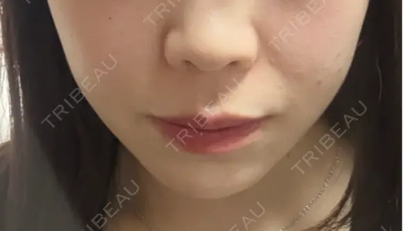 ボトックス（エラ・小顔） / ヒアルロン酸注入（鼻翼基部） KAGA CLINIC DAY 0 メイン用