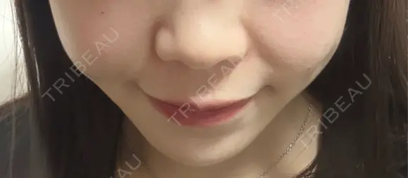 ボトックス（エラ・小顔） / ヒアルロン酸注入（鼻翼基部） KAGA CLINIC DAY 0 メイン用