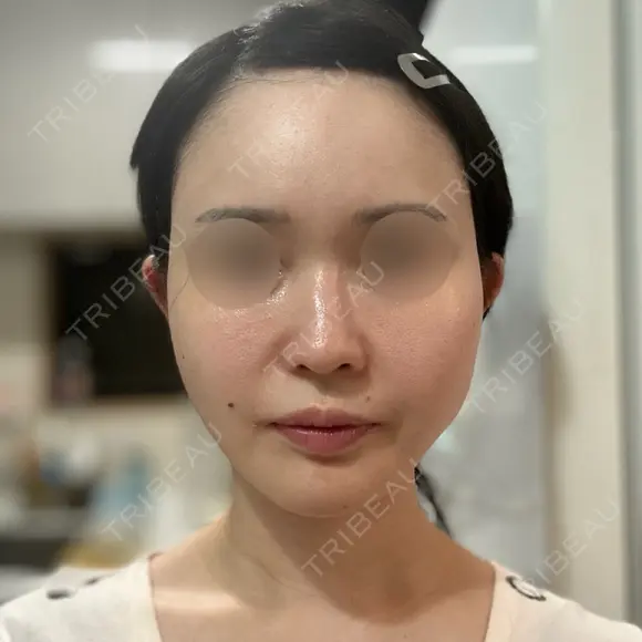 RF（高周波）たるみ治療 Chloe Cheongdam Clinic （クロエチョンダムクリニック） AFTER メイン用