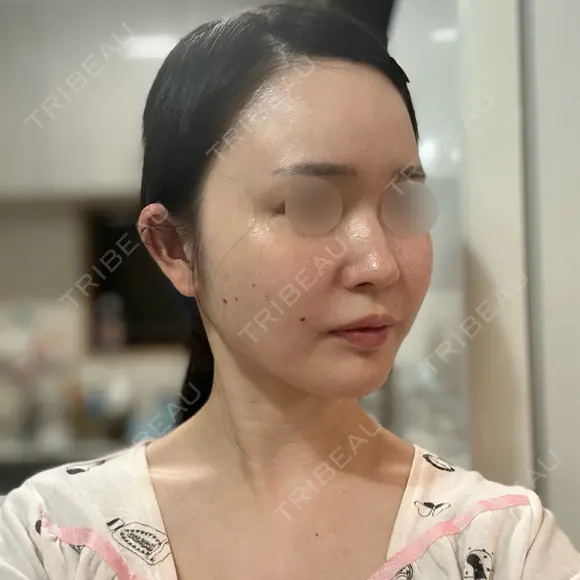 RF（高周波）たるみ治療 Chloe Cheongdam Clinic （クロエチョンダムクリニック） DAY 28 メイン用