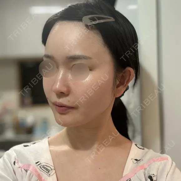 RF（高周波）たるみ治療 Chloe Cheongdam Clinic （クロエチョンダムクリニック） DAY 28 メイン用