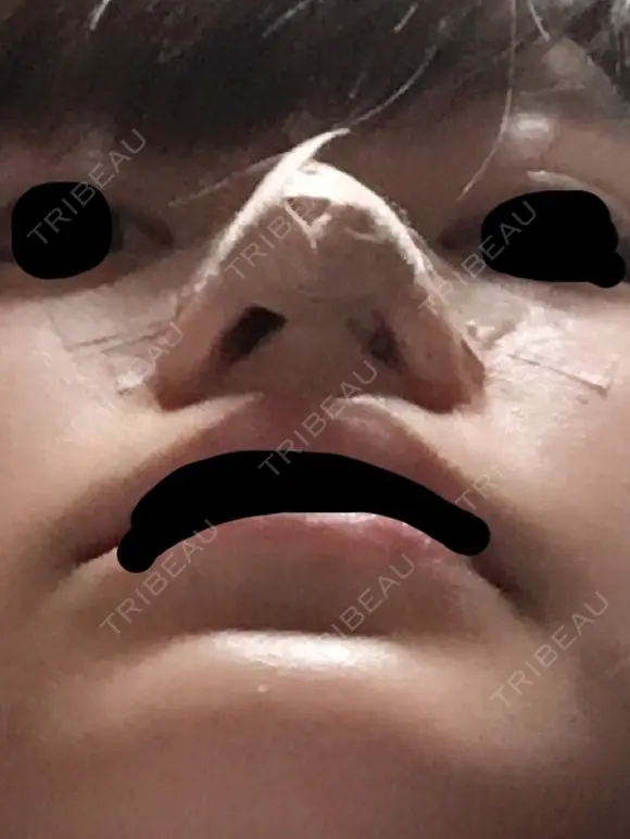 軟骨移植 三輪皮フ科形成外科 DAY 2 メイン用