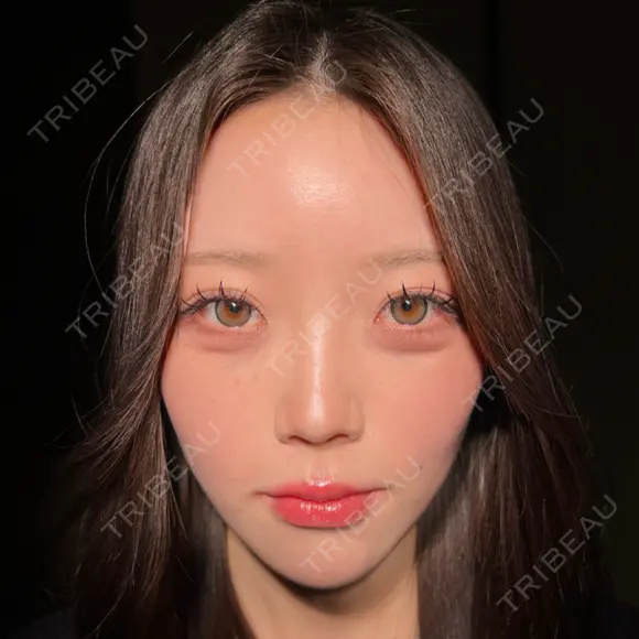 糸リフト / 脂肪吸引（顔） / インディバ（顔） / 美容点滴・美容注射（疲労回復） HAAB×DREAM BEAUTY CLINIC 東京本院 AFTER メイン用