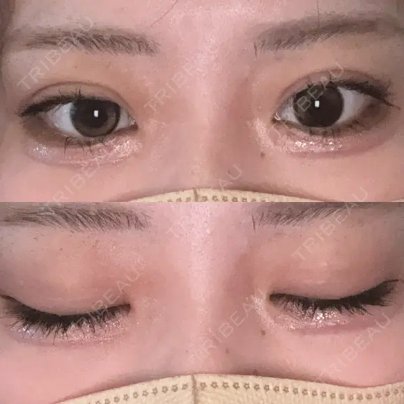 二重埋没 / 上まぶたの脂肪取り アリエル美容クリニック 横浜院 DAY 13 メイン用