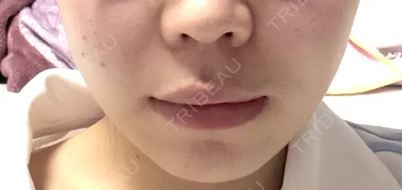 ボトックス（エラ・小顔） / ヒアルロン酸注入（鼻翼基部） KAGA CLINIC DAY 1 メイン用