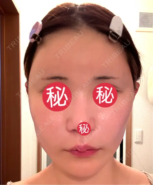 額を丸く / 脂肪注入（肌） / 脂肪注入（額） 湘南美容クリニック 柏院 DAY 22 メイン用