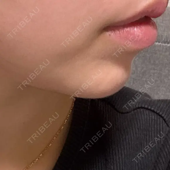 ボトックス（あご） フォンタナクリニック天神 DAY 3 メイン用