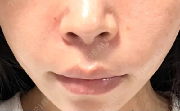 肌ヒアルロン酸注入（たるみ・シワ改善） MEMOTO CLINIC 名古屋 AFTER メイン用