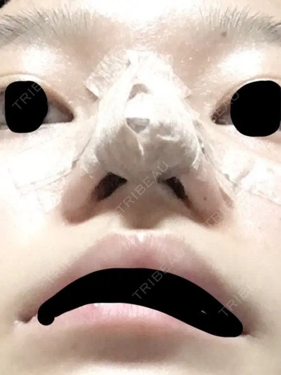 軟骨移植 三輪皮フ科形成外科 DAY 3 メイン用