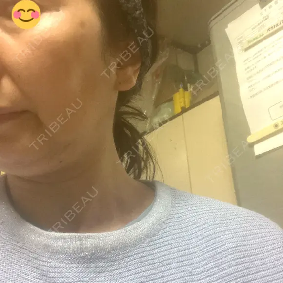 ルメッカ BAO CLINIC 神戸院 DAY 3 メイン用