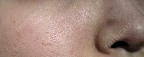 毛穴洗浄（ハイドラフェイシャルなど） / ピコフラクショナルレーザー（毛穴・ニキビ跡） 心斎橋KT美容クリニック AFTER メイン用